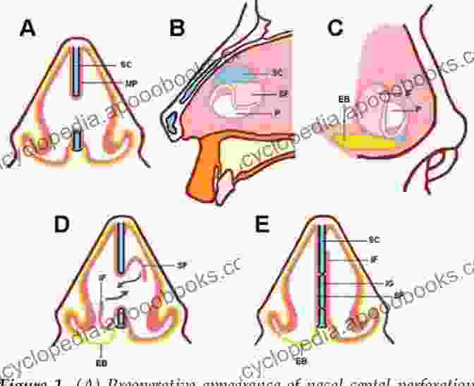 A Diagram Of A Nasoseptal Perforation Nasoseptal Perforations: Endoscopic Repair Techniques