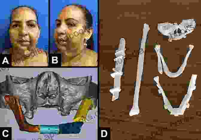 A Postoperative Photograph Of A Patient Who Has Undergone Mandibular Reconstruction With A Fibula Flap. Atlas Of Mandibular And Maxillary Reconstruction With The Fibula Flap: A Step By Step Approach