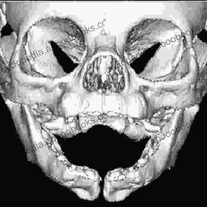 A Preoperative Photograph Of A Patient With A Mandibular Defect. Atlas Of Mandibular And Maxillary Reconstruction With The Fibula Flap: A Step By Step Approach