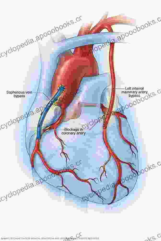 Advanced Techniques For Complex Off Pump Coronary Artery Bypass Cases Off Pump Coronary Artery Bypass