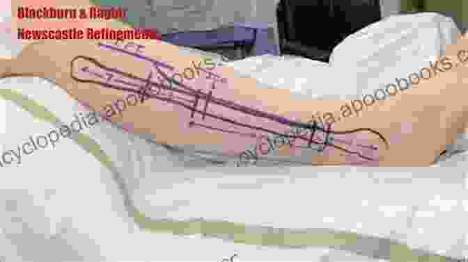 An Intraoperative Photograph Of A Surgeon Harvesting A Fibula Flap. Atlas Of Mandibular And Maxillary Reconstruction With The Fibula Flap: A Step By Step Approach