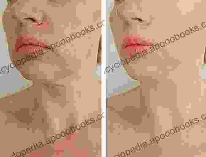 Before And After Microneedling Treatment Results For Skin Rejuvenation And Wrinkle Reduction Percutaneous Collagen Induction With Microneedling: A Step By Step Clinical Guide