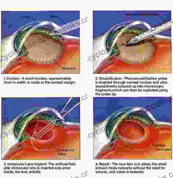 Brilliantly Illustrated Surgical Procedures, Showcasing The Intricacies Of Various Ophthalmic Interventions, From Cataract Removal To Retinal Detachment Repair. Color Atlas Of Ophthalmology: The Quick Reference Manual For Diagnosis And Treatment