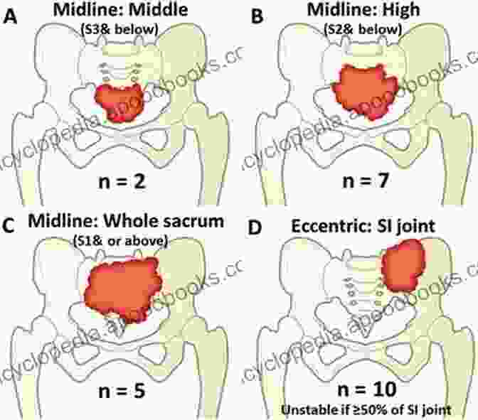 Case Studies Of Pelvic And Sacral Tumors Surgery Of The Pelvic And Sacral Tumor