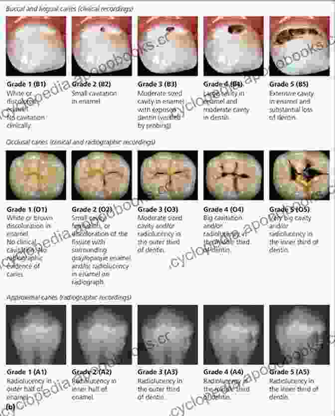 Clinical Photograph Of A Dental Caries Lesion Atlas Of Oral Diseases: A Guide For Daily Practice