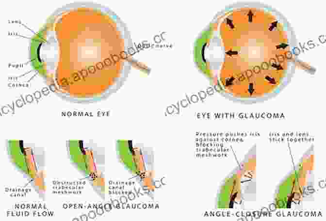 Comparison Of Normal And Glaucomatous Anterior Chamber Angle Atlas Of Anterior Segment Optical Coherence Tomography (Essentials In Ophthalmology)