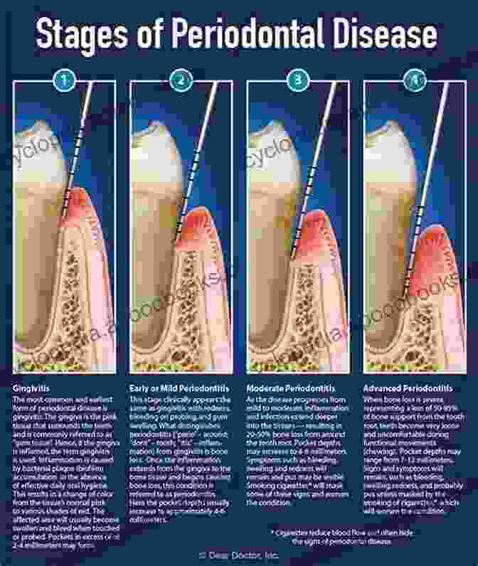 Diagram Illustrating The Stages Of Periodontal Disease Atlas Of Oral Diseases: A Guide For Daily Practice