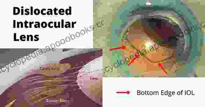 Dislocated Lens In A Patient's Eye Practical Emergency Ophthalmology Handbook: An Algorithm Based Approach To Ophthalmic Emergencies