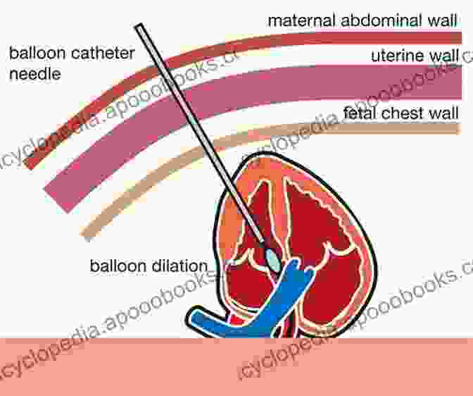 Fetal Intervention Procedure Fetal And Hybrid Procedures In Congenital Heart Diseases