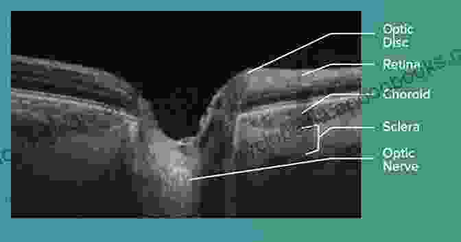 High Resolution OCT Image Of The Retina And Optic Nerve Head Optical Coherence Tomography In Glaucoma: A Practical Guide