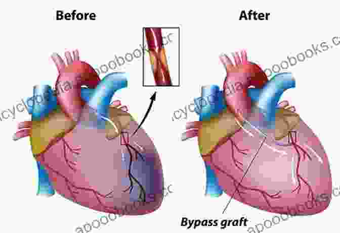 Historical Timeline Of Off Pump Coronary Artery Bypass Off Pump Coronary Artery Bypass