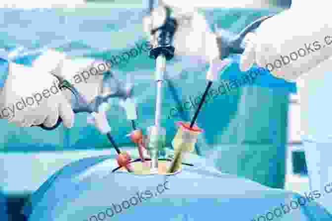 Image Of A Laparoscopic Surgery In Progress, Displaying The Surgeon's Hands Manipulating Laparoscopic Instruments Through Small Incisions. Management Of Gastroesophageal Reflux Disease: Surgical And Therapeutic Innovations