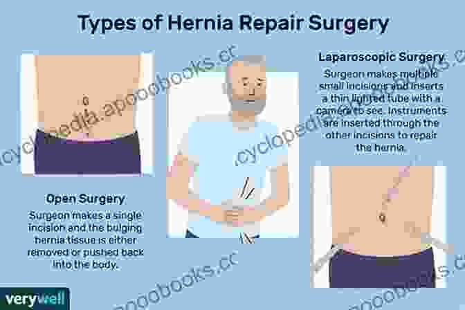 Laparoscopic Inguinal Hernia Repair Surgery Surgical Dictations: Laparoscopic Inguinal Hernia Repair