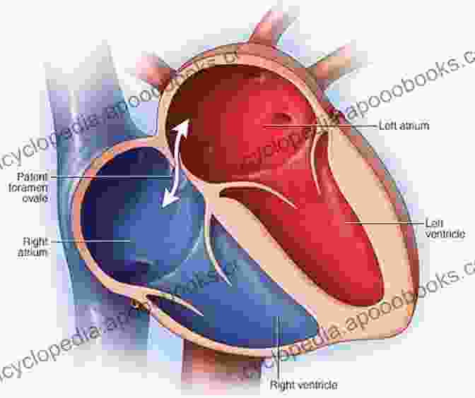 Patent foramen ovale