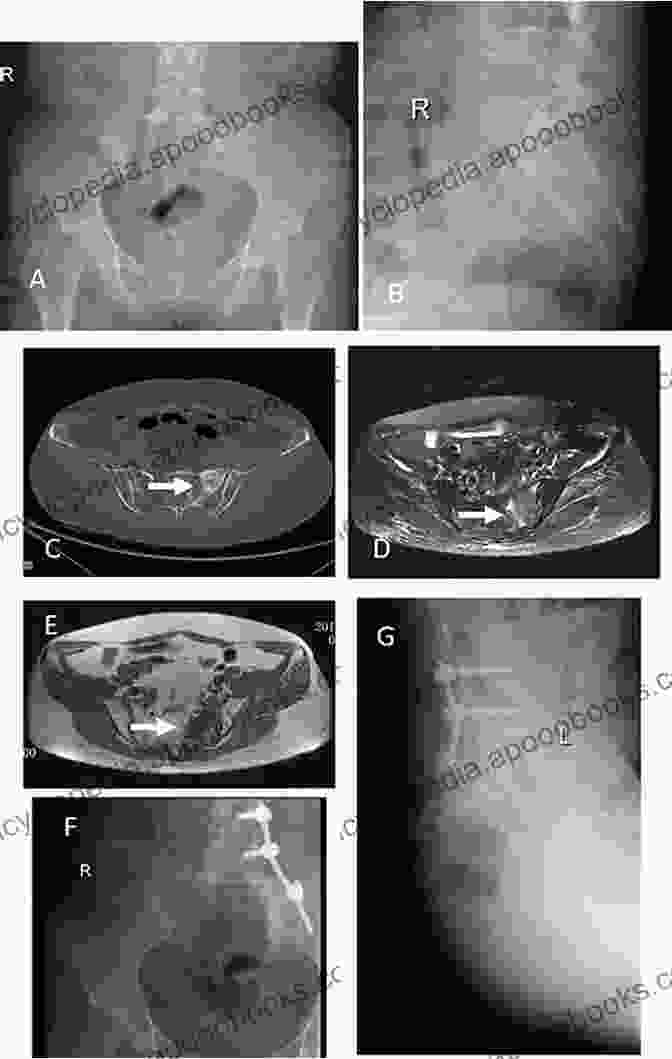 Patient Outcomes In Pelvic And Sacral Tumor Surgery Surgery Of The Pelvic And Sacral Tumor