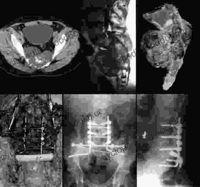 Surgical Excellence In Pelvic And Sacral Tumor Surgery Surgery Of The Pelvic And Sacral Tumor