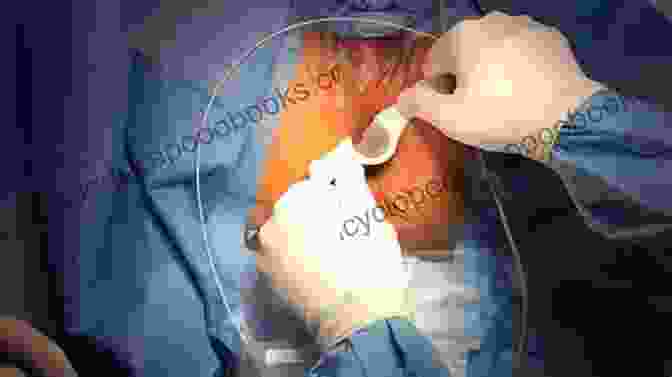 Surgical Treatment Of Hemorrhoids Zemback Surgical Treatment Of Hemorrhoids A H Zemback