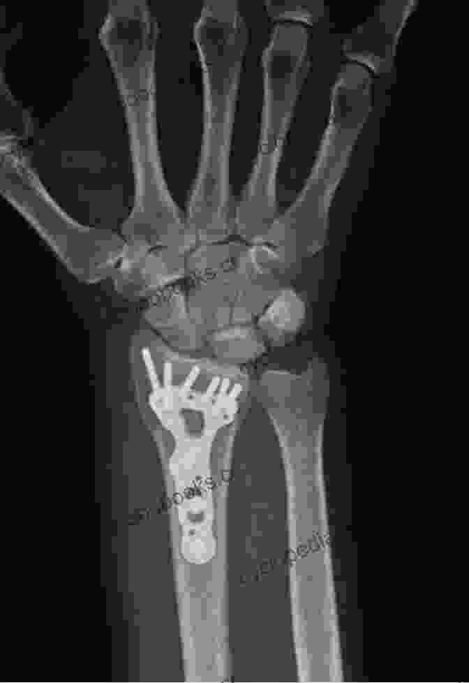 X Ray Of A Distal Radius Fracture Distal Radius Fractures: Evidence Based Management