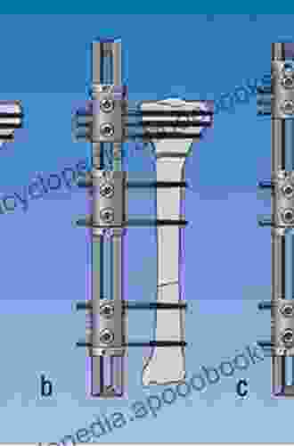 Advanced Techniques in Limb Reconstruction Surgery