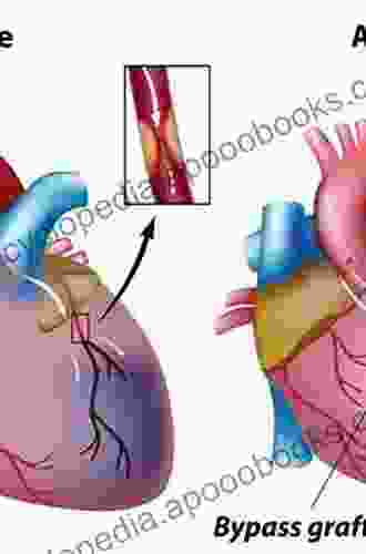 Off Pump Coronary Artery Bypass