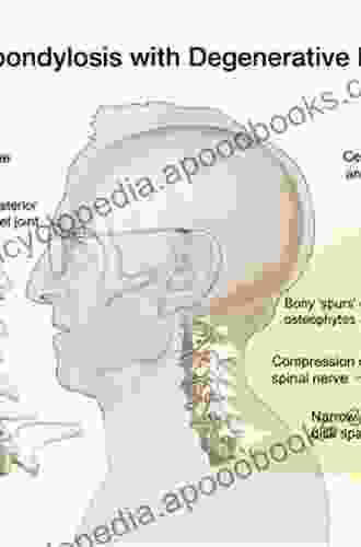 Degenerative Diseases of the Cervical Spine: Therapeutic Management in the Subaxial Section