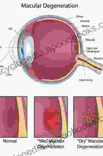 Vitreous: In Health And Disease